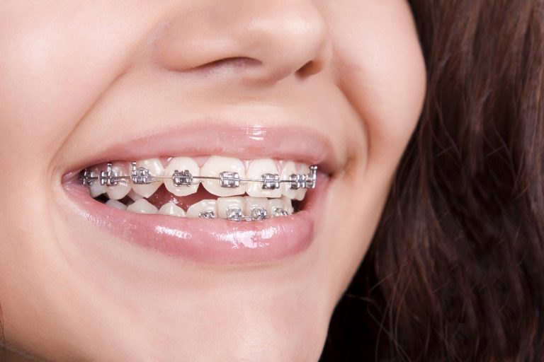 Metal Braces for Teeth